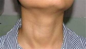 甲亢有法吃瓜了吗,法式吃瓜，健康生活新选择